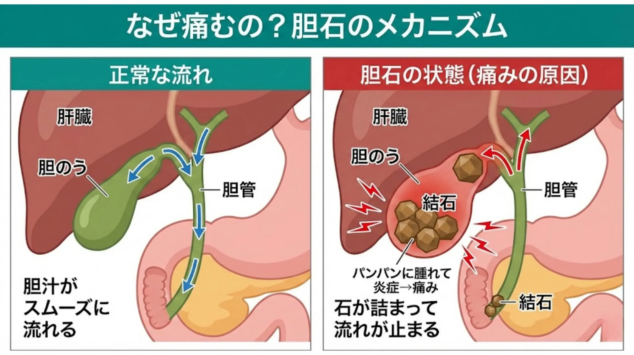 胆のう・胆管の病気（胆石・胆のう炎など） | 北柏の内科・発熱外来